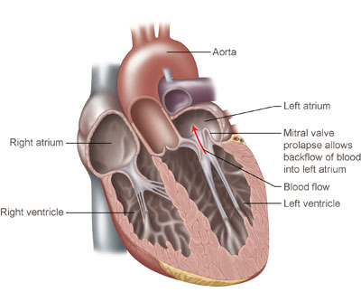 Life Insurance with Mitral Valve Prolapse - Rootfin